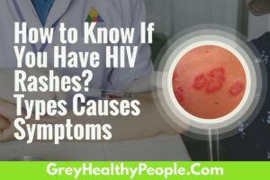 How to Know If You Have an HIV Rash? HIV Rashes Types Causes